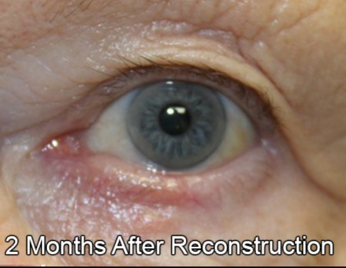 Eyelid Reconstruction After Skin Cancer