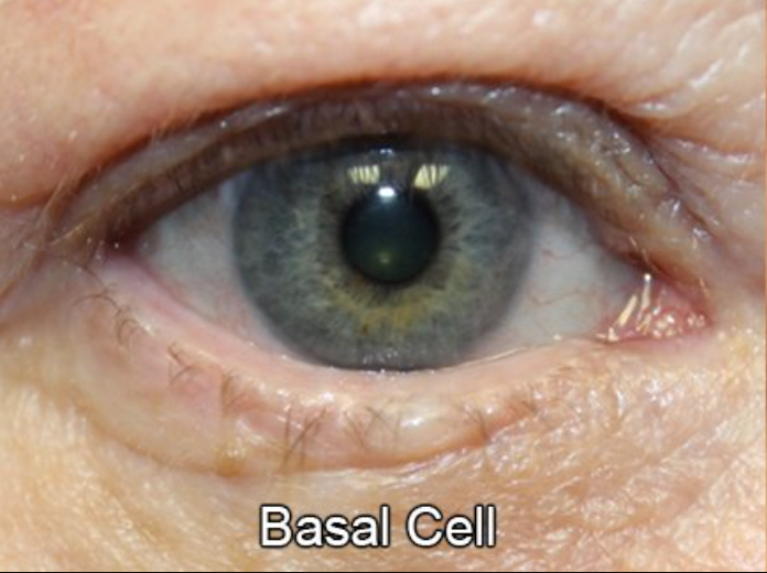 Eyelid Reconstruction After Skin Cancer