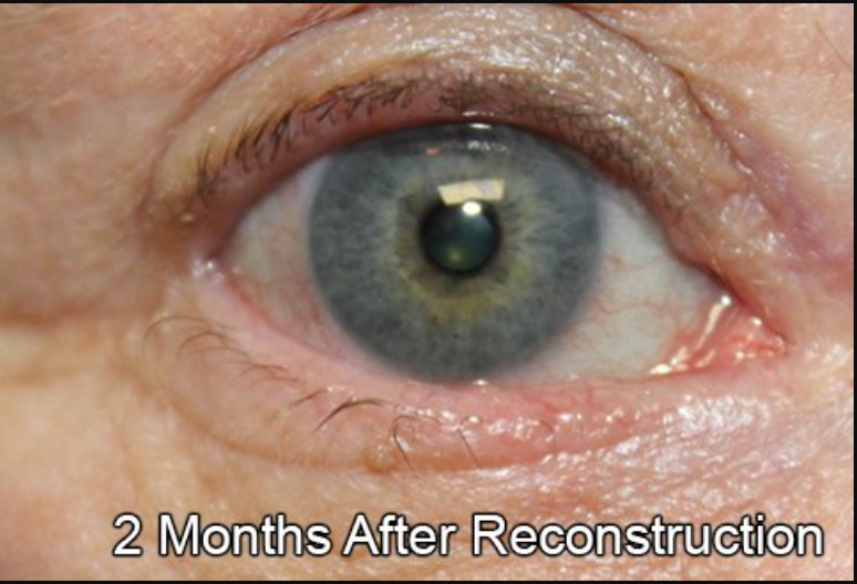 Eyelid Reconstruction After Skin Cancer
