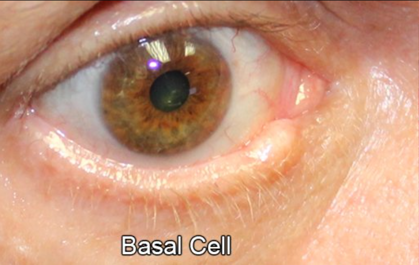 Eyelid Reconstruction After Skin Cancer