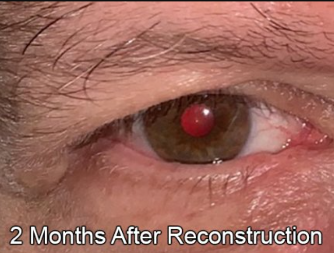Eyelid Reconstruction After Skin Cancer