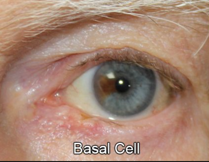 Eyelid Reconstruction After Skin Cancer
