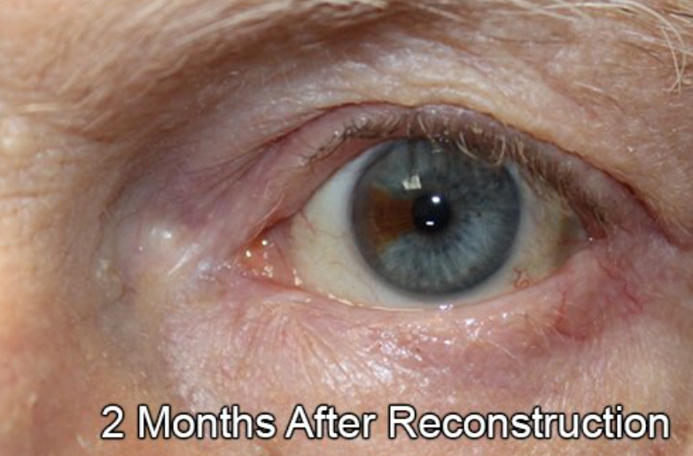 Eyelid Reconstruction After Skin Cancer