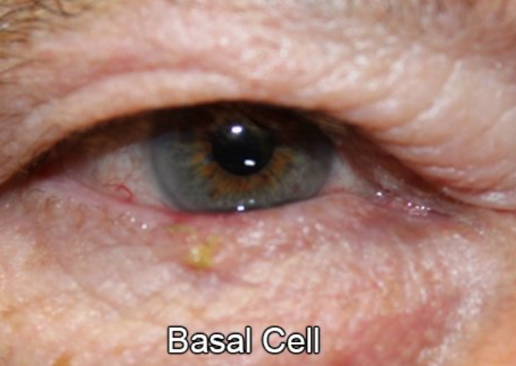 Eyelid Reconstruction After Skin Cancer