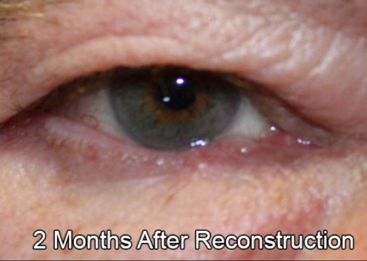 Eyelid Reconstruction After Skin Cancer