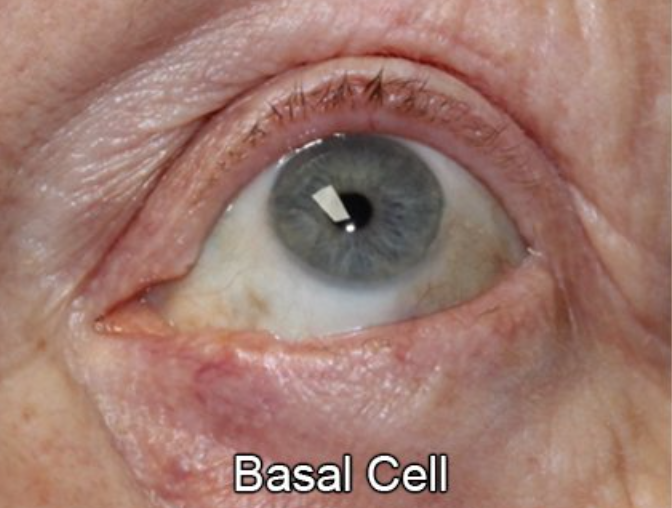 Eyelid Reconstruction After Skin Cancer