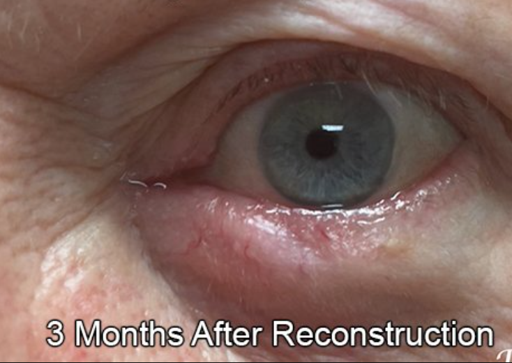 Eyelid Reconstruction After Skin Cancer