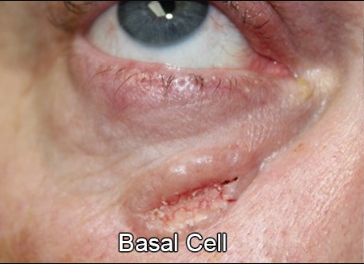 Eyelid Reconstruction After Skin Cancer