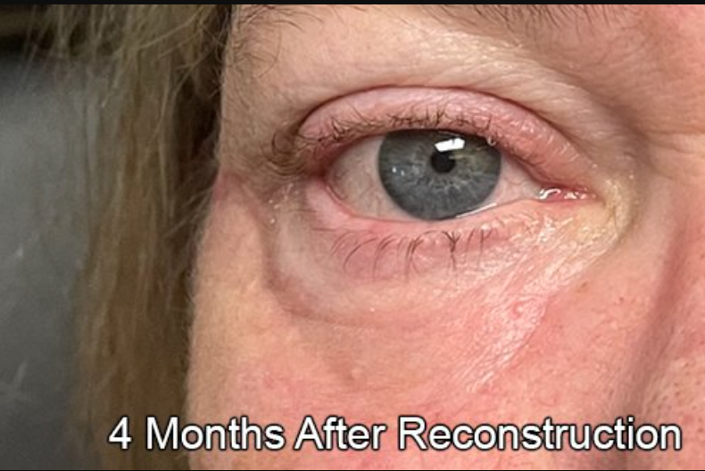 Eyelid Reconstruction After Skin Cancer