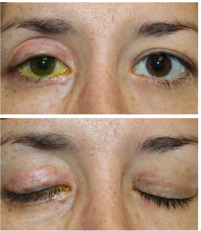 Placement of Gold Weight and Lateral Tarsorrhaphy for Paralysis of Eyelid Closure After