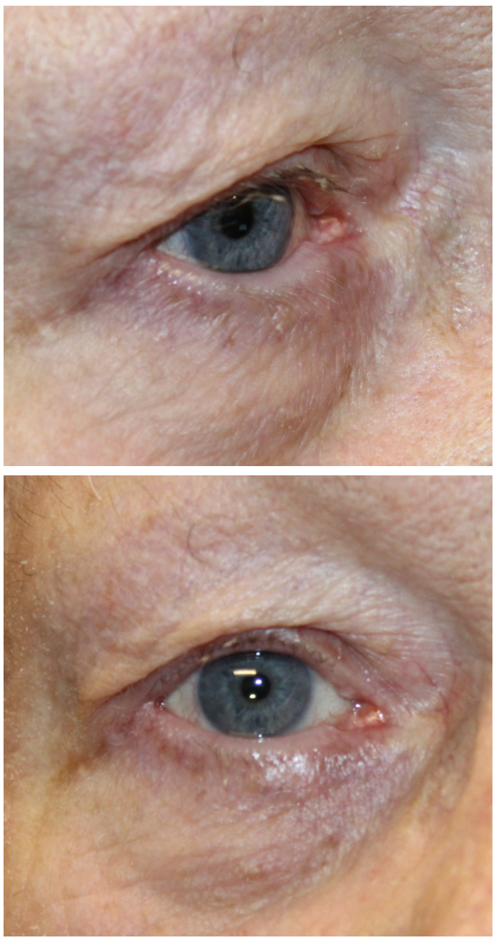 Entropion Repair After