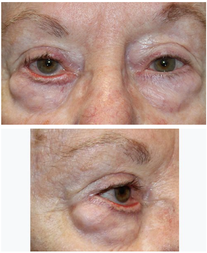 Ectropion Repair using a Skin Graft Before
