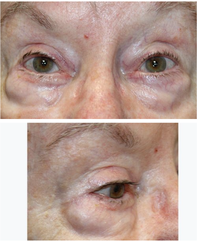 Ectropion Repair using a Skin Graft After
