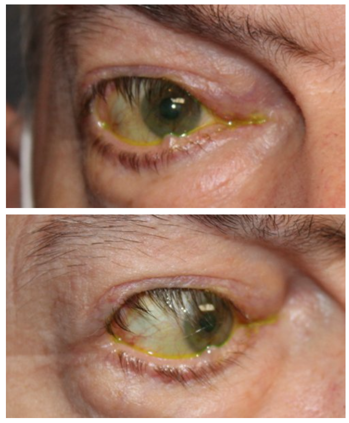 Cicatricial Entropion and Eyelid Retraction Repair Before