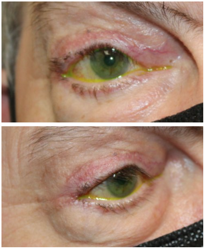 Cicatricial Entropion and Eyelid Retraction Repair After