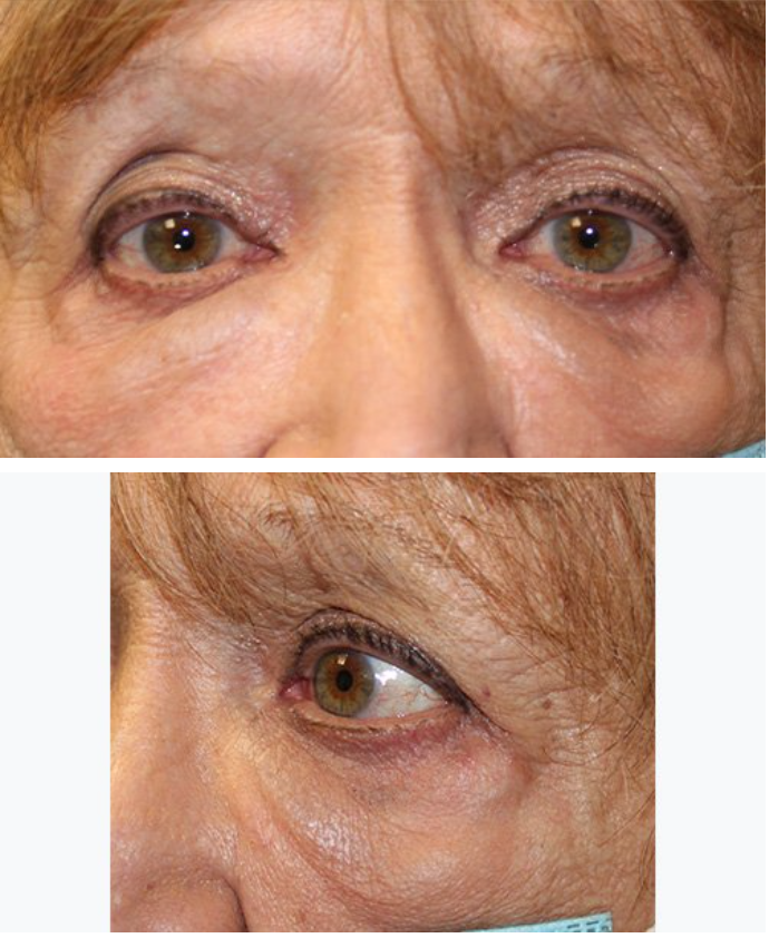Single Doxycycline Injection for Festoons Before