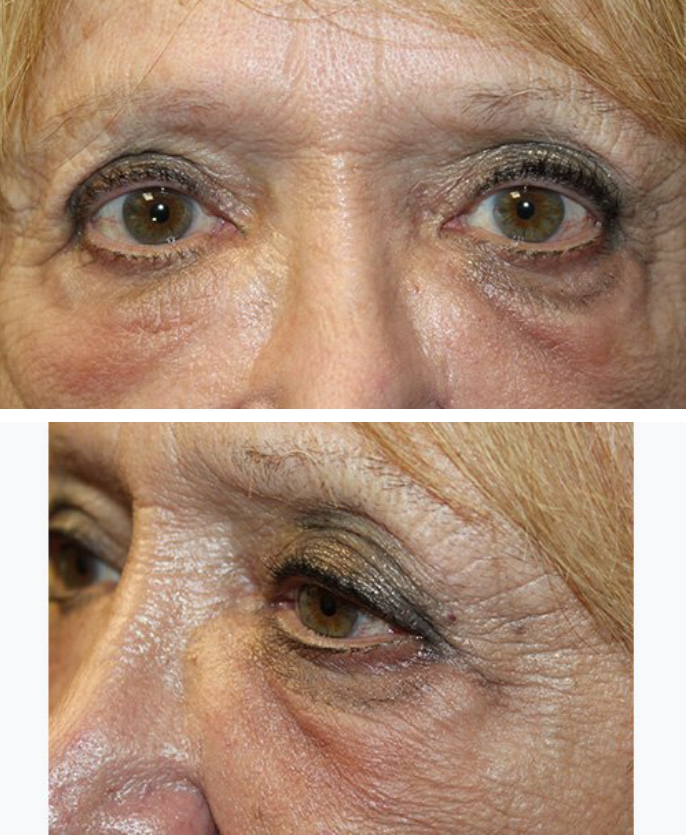 Single Doxycycline Injection for Festoons After