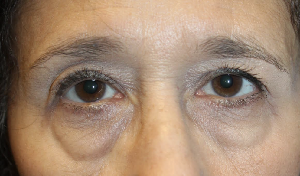 Bilateral upper blepharoplasty Bilateral cosmetic lower blepharoplasty Before