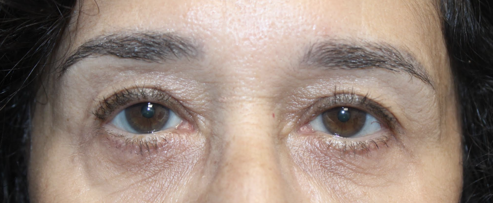 Bilateral upper blepharoplasty Bilateral cosmetic lower blepharoplasty After