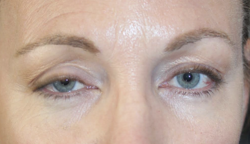 Right upper eyelid ptosis repair Before