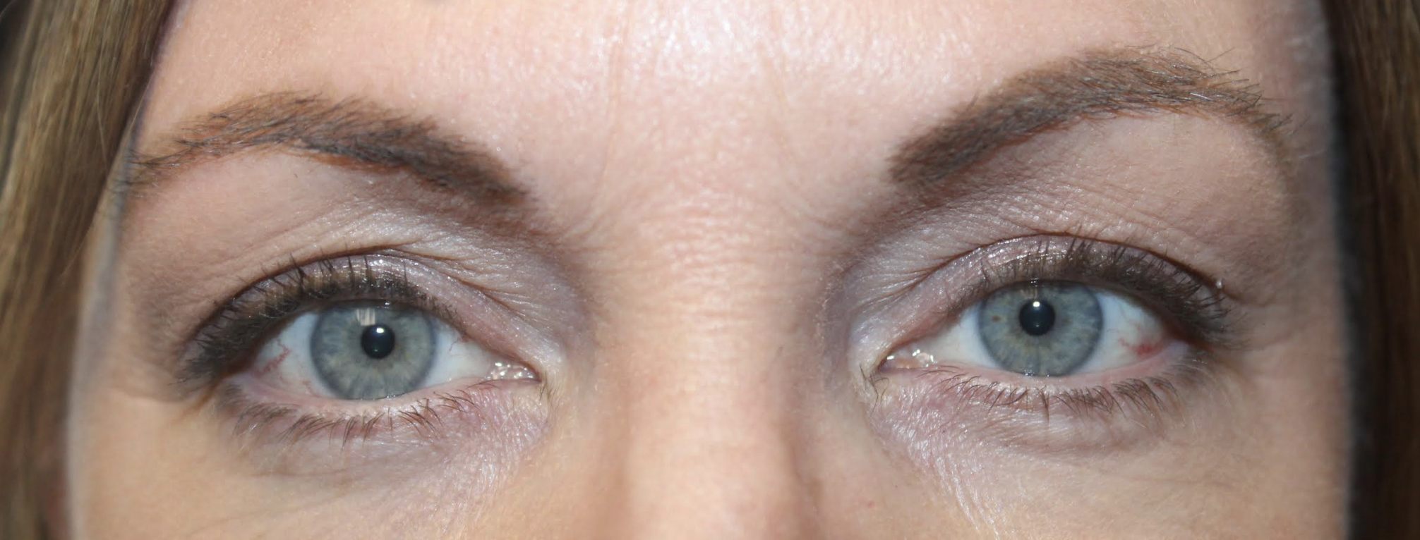 Right upper eyelid ptosis repair After