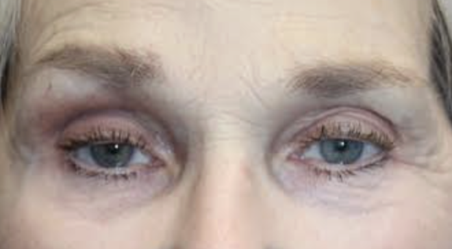 Bilateral Upper Eyelid Ptosis Repair Before