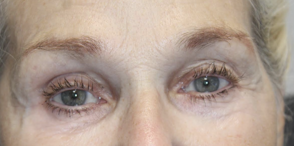 Bilateral Upper Eyelid Ptosis Repair After