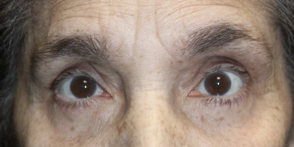 Bilateral Upper Blepharoplasty, Bilateral Brow lifting, Bilateral Cosmetic Lower Blepharoplasty & Bilateral Ptosis Repair After