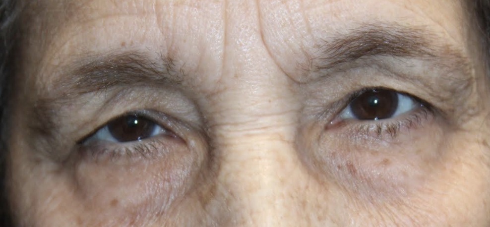 Bilateral Upper Blepharoplasty, Bilateral Brow lifting, Bilateral Cosmetic Lower Blepharoplasty & Bilateral Ptosis Repair Before