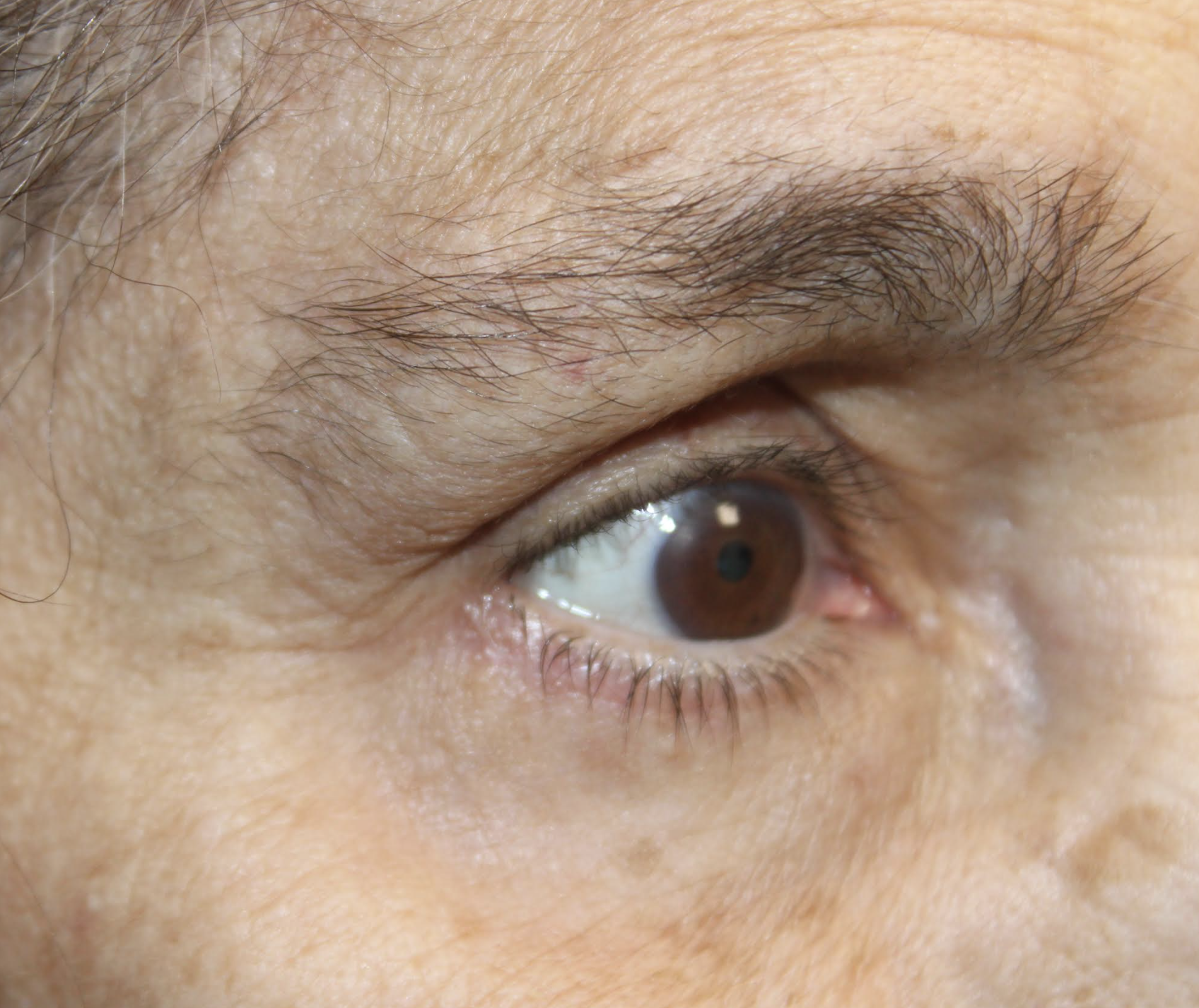 Bilateral Cosmetic Upper and Lower Blepharoplasty & Bilateral Browlift After