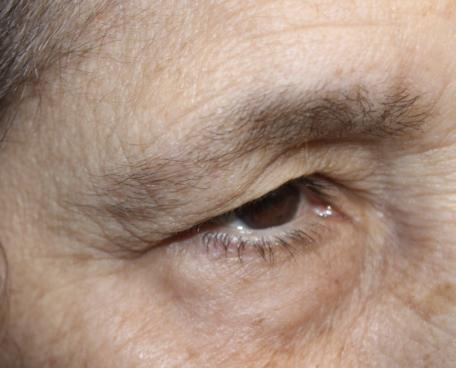 Bilateral Cosmetic Upper and Lower Blepharoplasty & Bilateral Browlift Before