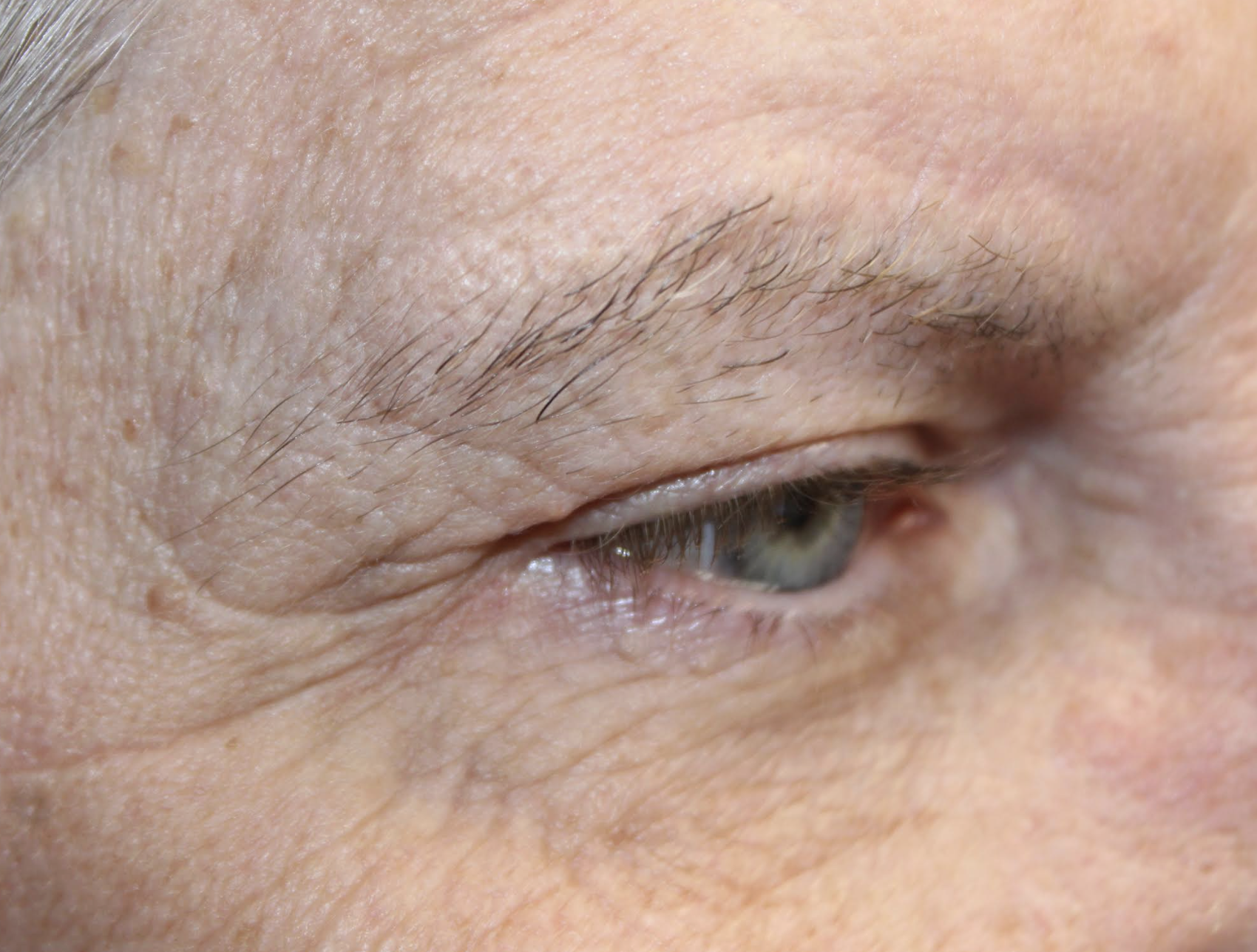 Bilateral Upper Blepharoplasty Bilateral Browlift Bilateral Cosmetic Lower Blepharoplasty Before