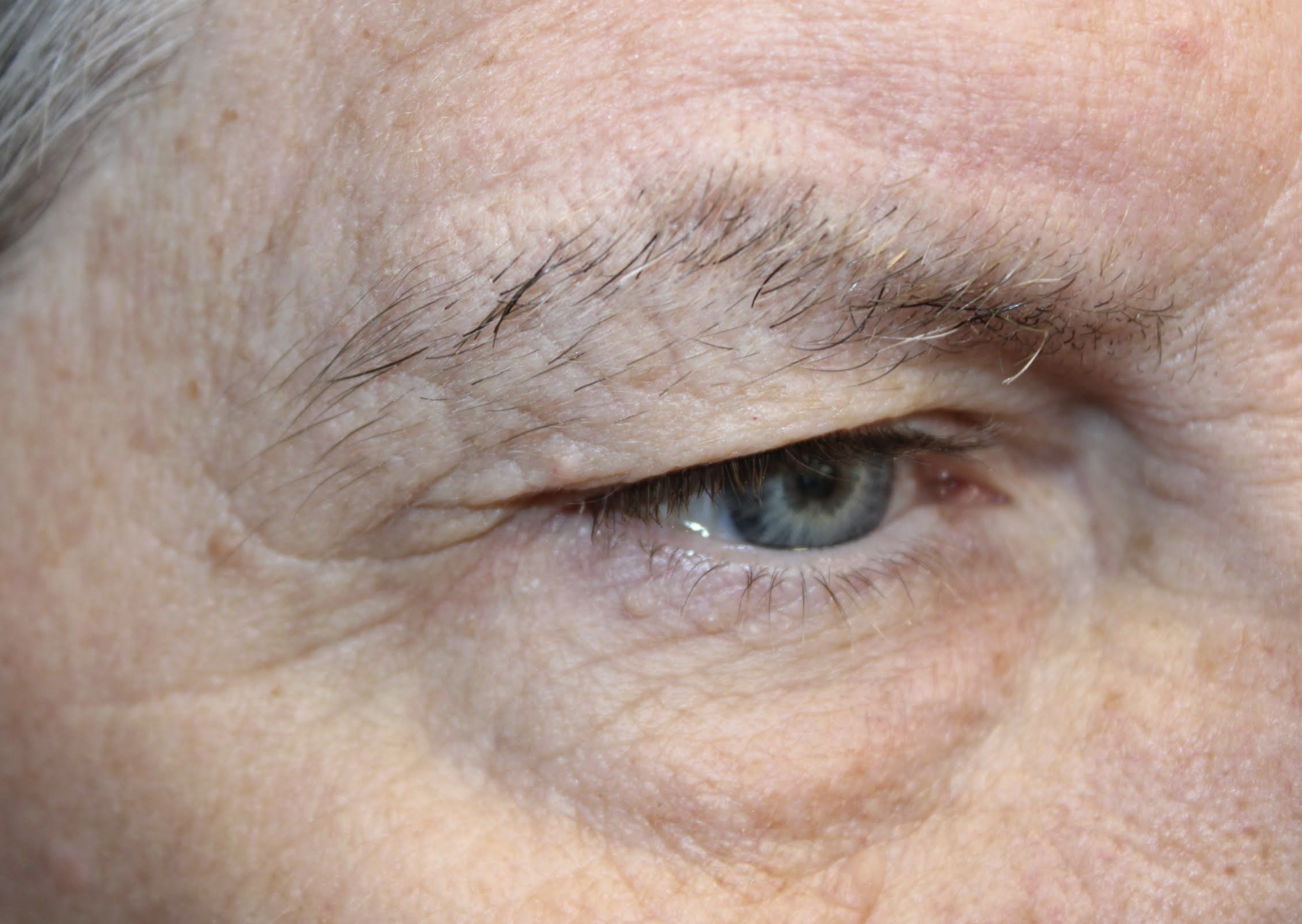 Bilateral Upper Blepharoplasty Bilateral Browlift Bilateral Cosmetic Lower Blepharoplasty After