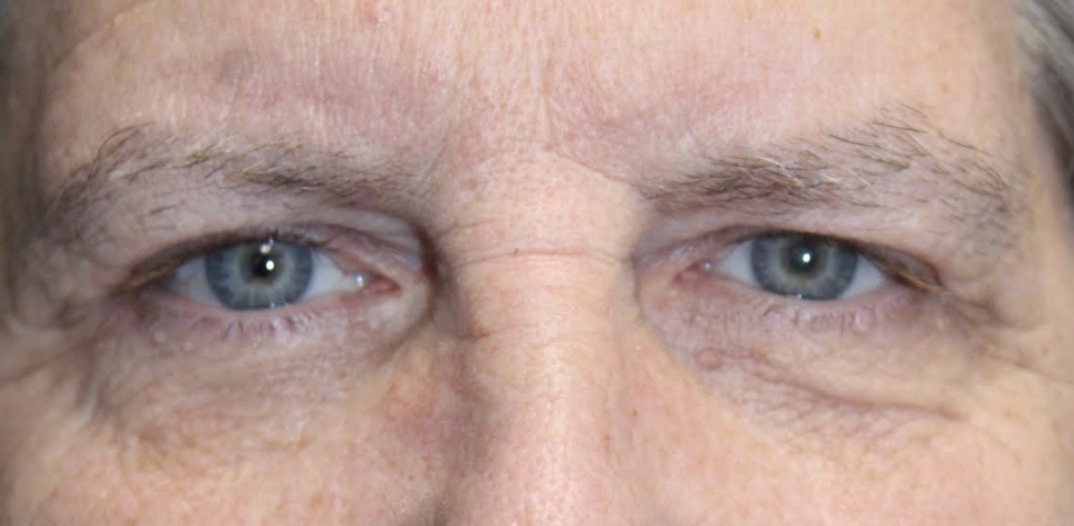 Bilateral Upper Blepharoplasty Bilateral Browlift Bilateral Cosmetic Lower Blepharoplasty After