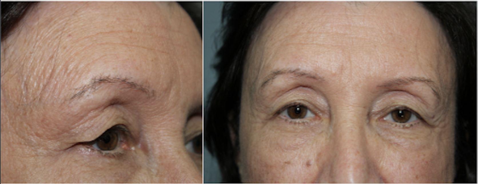 Cosmetic Upper and Lower Blepharoplasty Before