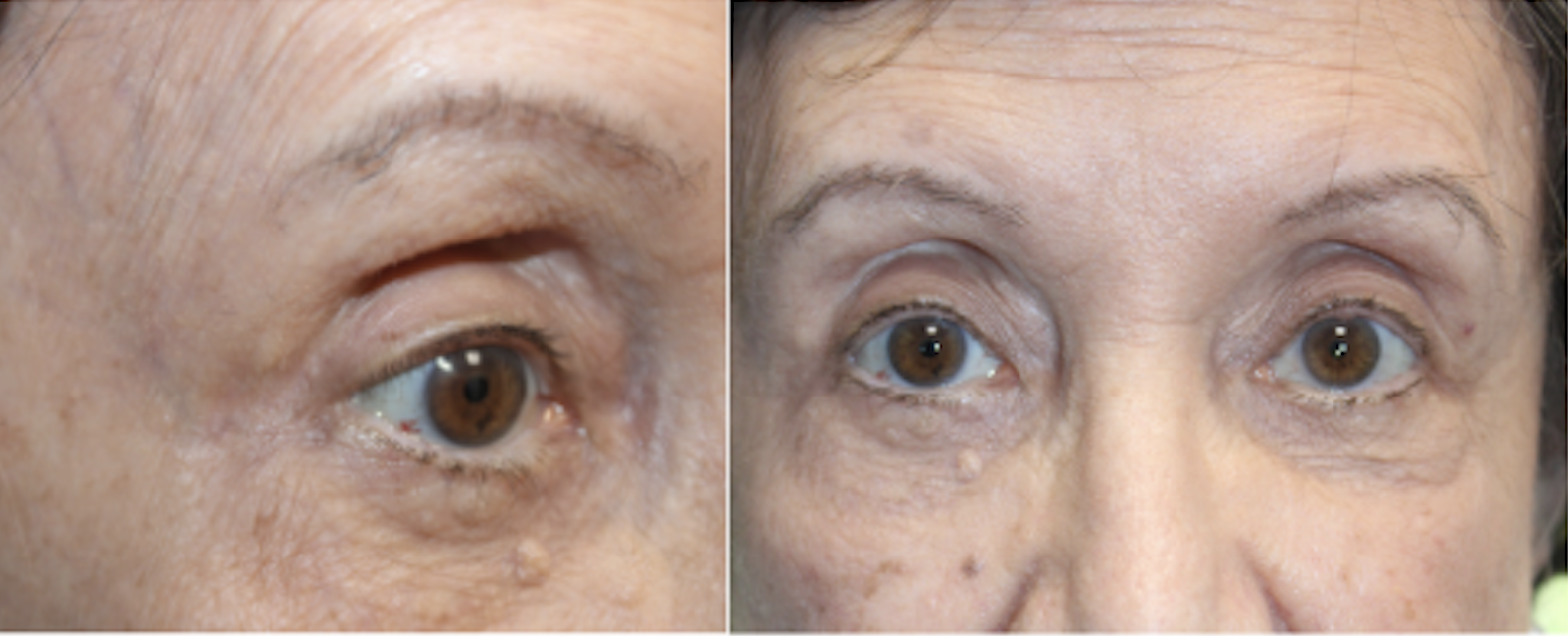 Cosmetic Upper and Lower Blepharoplasty After
