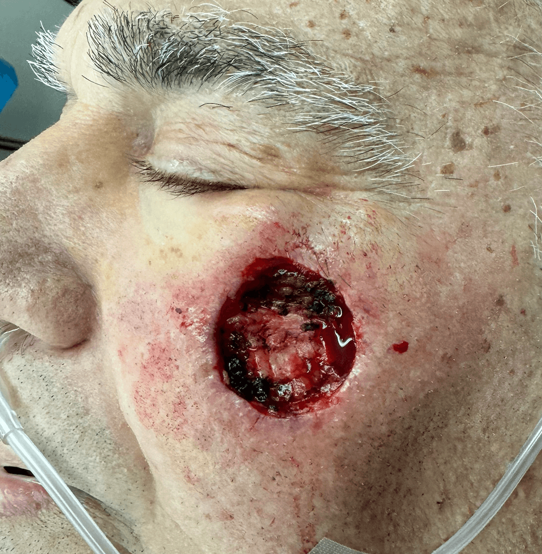 Squamous Cell Carcinoma Post Op