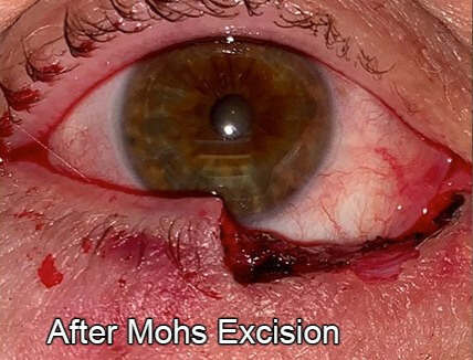 Eyelid Reconstruction After Skin Cancer After Mohs Extraction