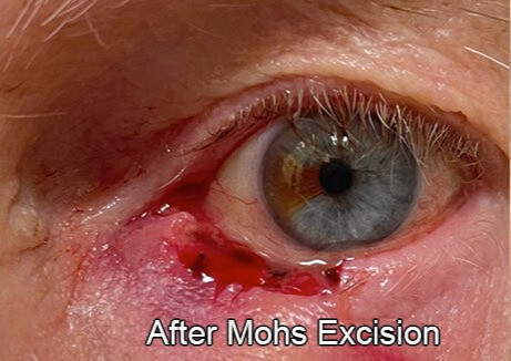 Eyelid Reconstruction After Skin Cancer After Mohs Excision