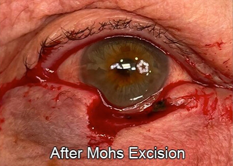 Eyelid Reconstruction After Skin Cancer After Mohs Excision