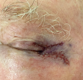 Mohs Reconstruction of the Left Lower Eyelid for Basal Cell Carcinoma (Post-Operative Month 1) After