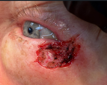 Mohs Reconstruction of the Left Lower Eyelid for Basal Cell Carcinoma (Post-Operative Month 1) After Surgery