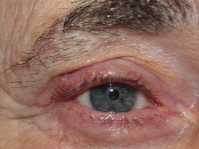 RUL Lesion Excision (Post-Operative Week 2) After