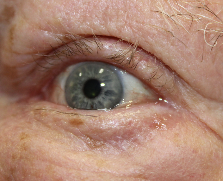 Mohs Reconstruction of the Left Lower Eyelid for Basal Cell Carcinoma (Post-Operative Month 1) Before