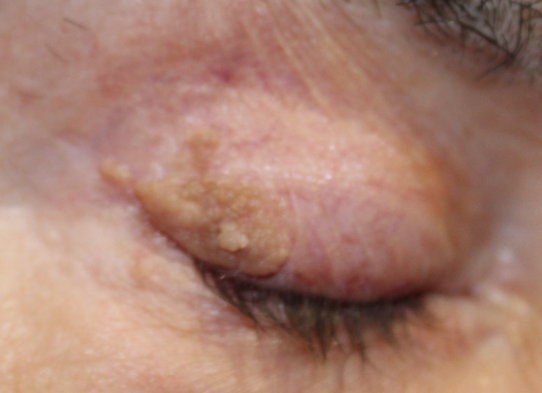 RUL Lesion Excision (Post-Operative Week 2) Before