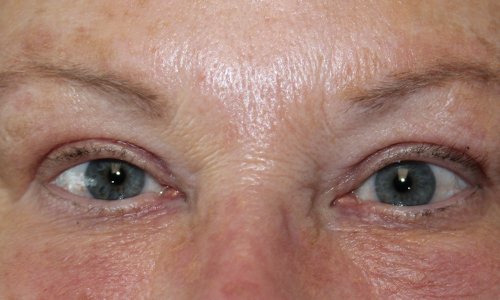 Upper Blepharoplasty After