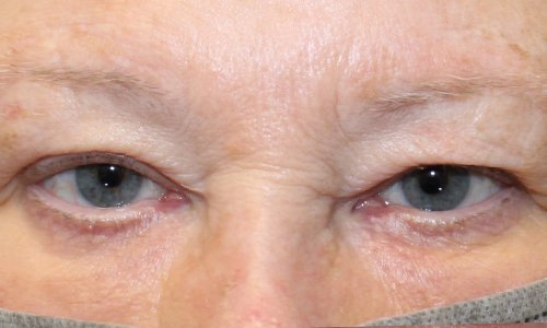 Upper Blepharoplasty Before
