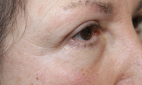 Upper Blepharoplasty to Revitalize Eyes After