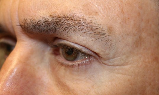 Blepharoplasty to revitalize left eye After