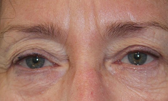 Upper & Lower Blepharoplasty Before